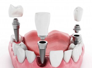 Этапы имплантации зубов в клинике