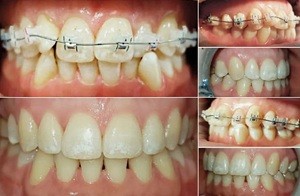 Брекеты при пародонтозе